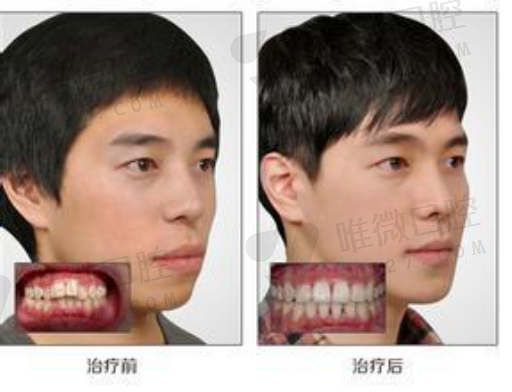 牙套和活动牙的优缺点（活动种植假牙的利与弊）(图1)